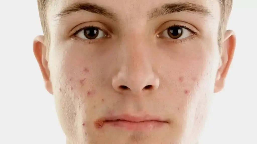 men with acne